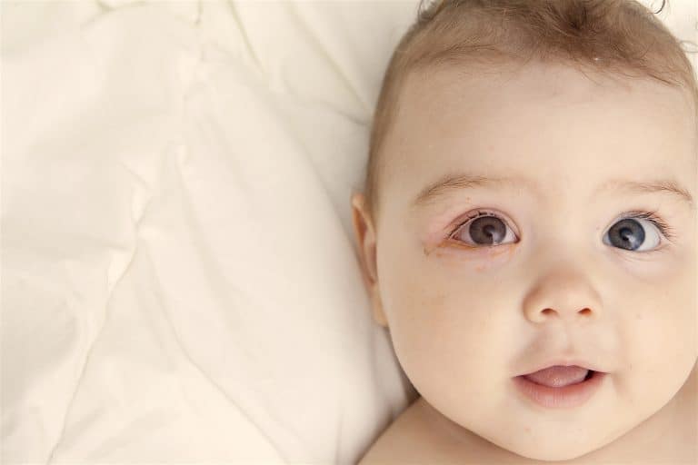 Cómo tratar la conjuntivitis en el recién nacido