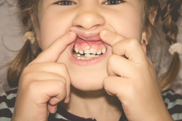 ¿Qué son los dientes de tiburón en niños?