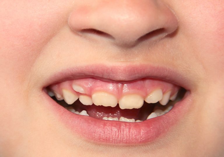 ¿Qué son los dientes de tiburón en niños?