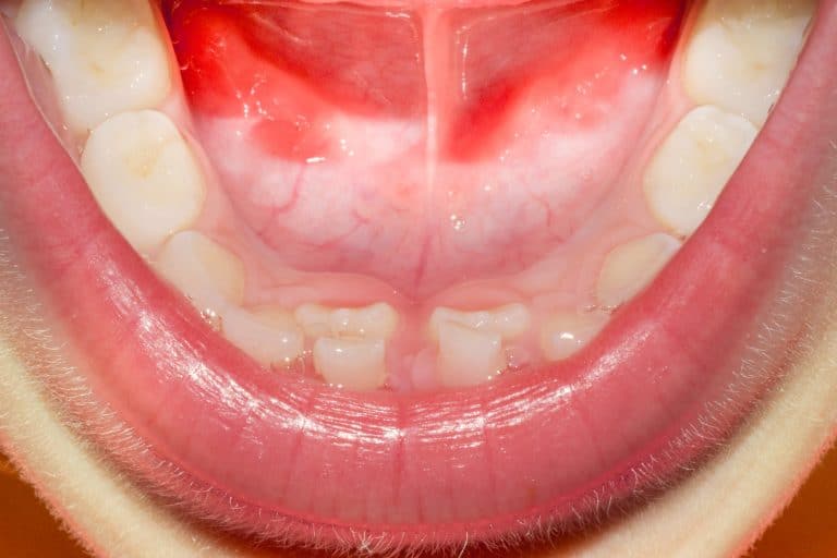 ¿Qué son los dientes de tiburón en niños?