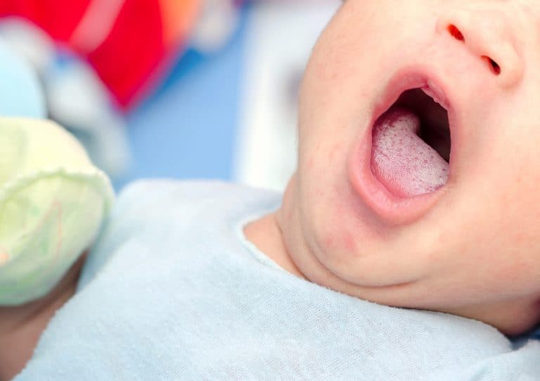 lengua blanca ¿Qué pasa si mi bebé tiene la lengua blanca?