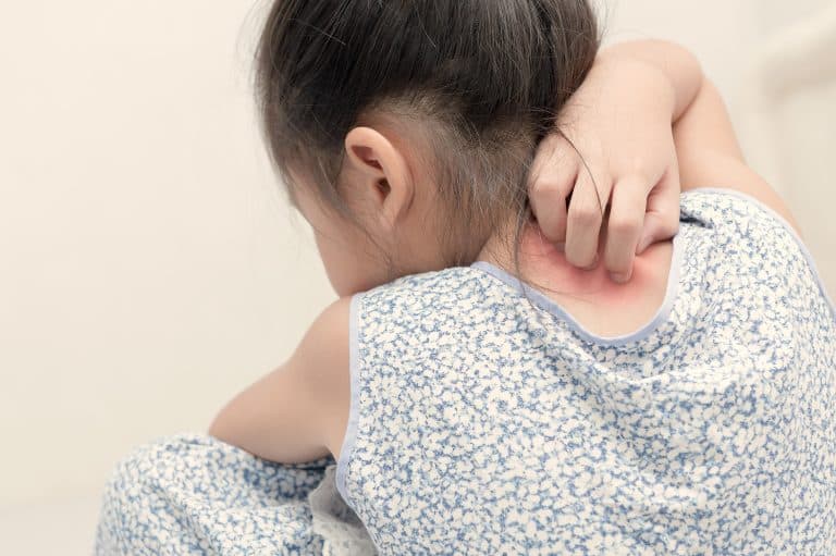 psoriasis en los niños Psoriasis en los niños: Causas, síntomas y tratamiento