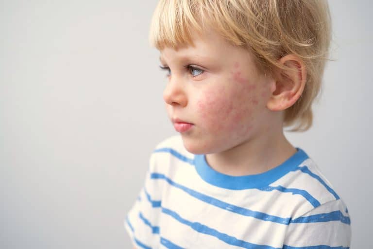 ¿Qué pruebas haya para realizar un diagnóstico de alergia a niños?