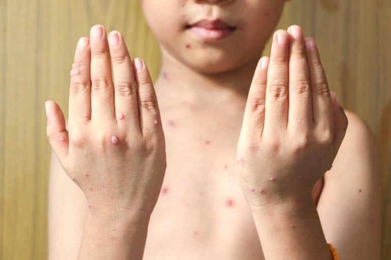 varicela niños Varicela en niños: Síntomas y tratamiento