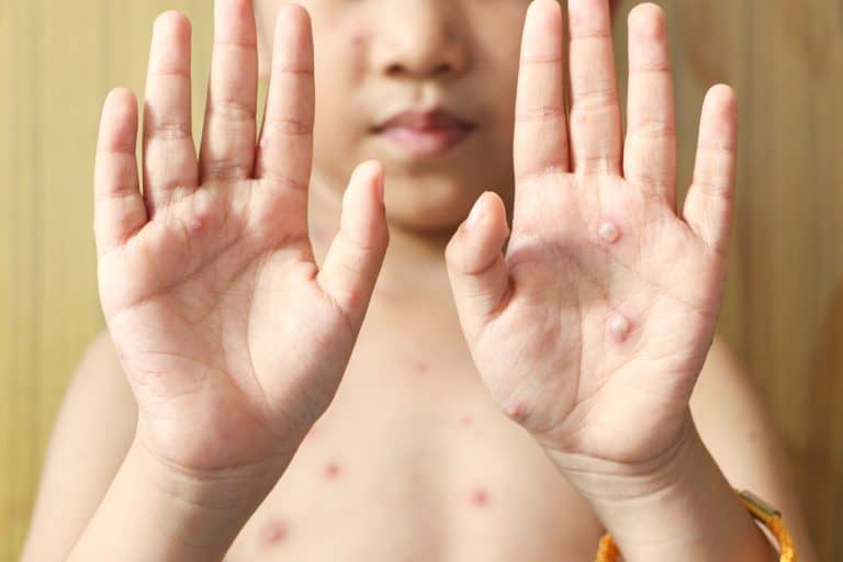 varicela niños Varicela en niños: Síntomas y tratamiento