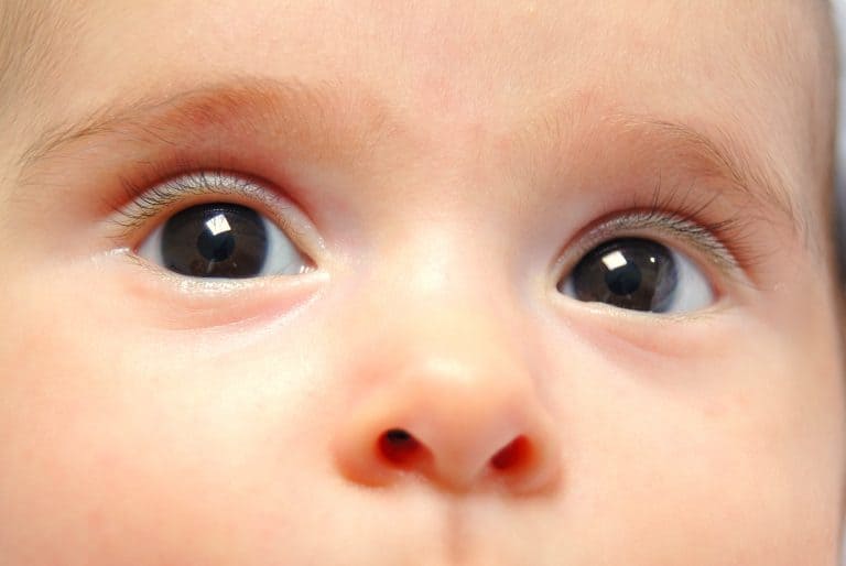 aniridia en los niños Aniridia en los niños: Qué es, qué la provoca