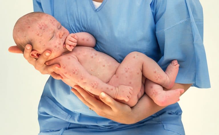 viruela del mono La viruela del mono puede ser grave en niños y embarazadas