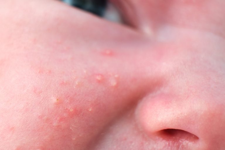 acné neonatal Acné neonatal: Qué es, tratamiento y duración