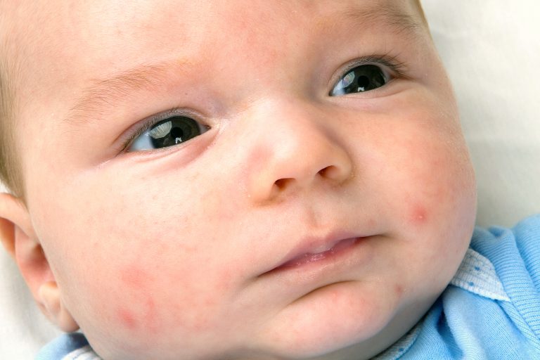 acné neonatal Acné neonatal: Qué es, tratamiento y duración