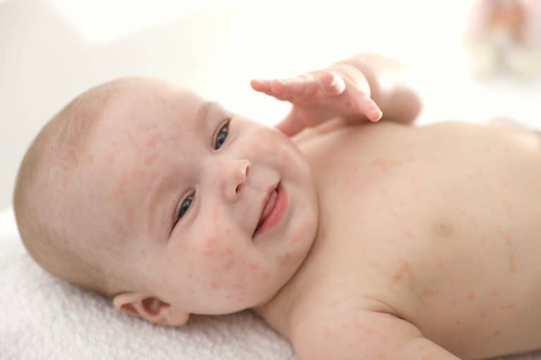 acné neonatal Acné neonatal: Qué es, tratamiento y duración