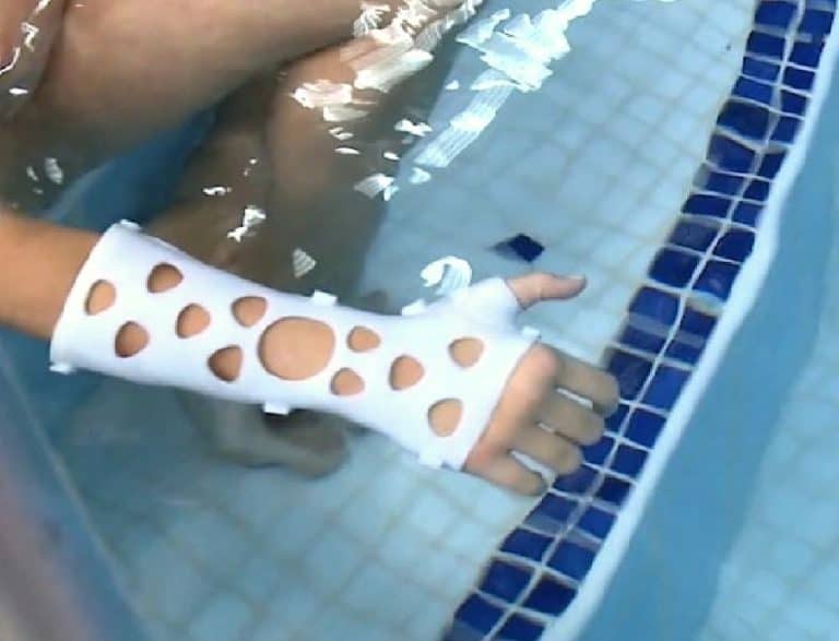 férulas en 3D Bañarse con brazo roto ya es posible gracias a las férulas en 3D