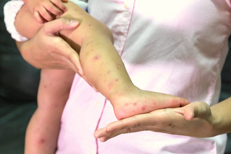 Gripe del tomate, la nueva infección que ataca a los niños