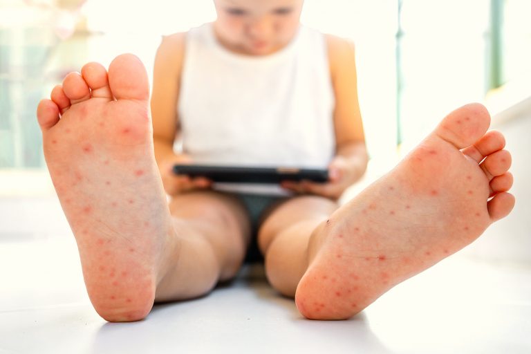 Gripe del tomate, la nueva infección que ataca a los niños