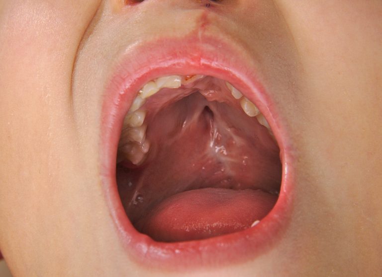 Labio leporino Labio leporino: Causas, consecuencias y solución