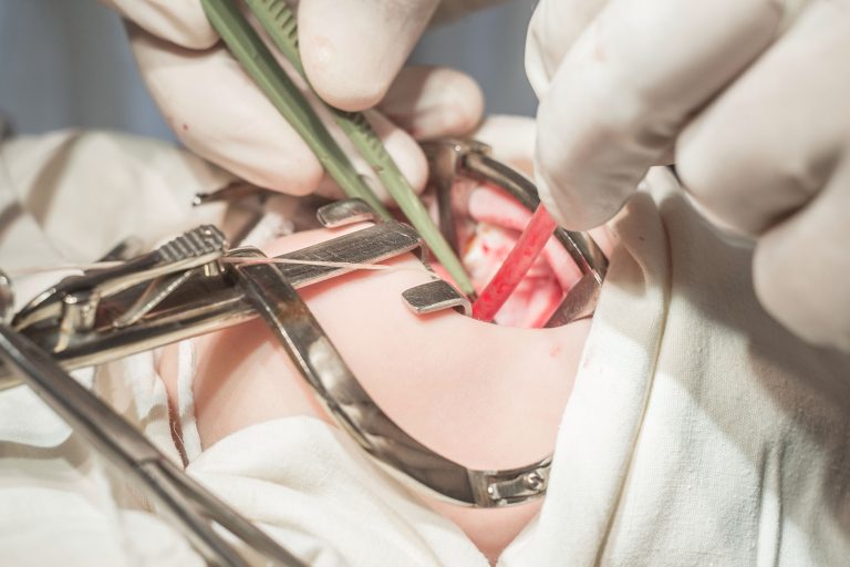 Labio leporino Labio leporino: Causas, consecuencias y solución