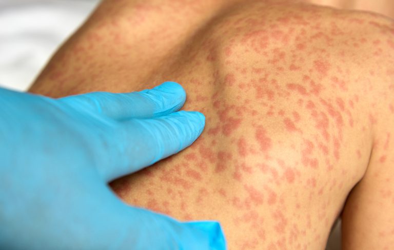 sarampión en Europa La OMS alerta del incremento del sarampión en Europa