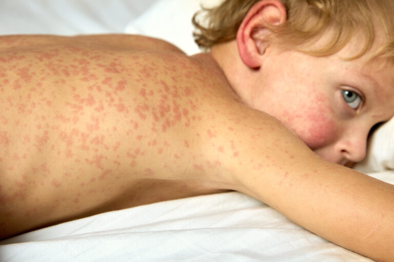 dermatitis atópica y depresión Más riesgo de depresión en niños con dermatitis atópica