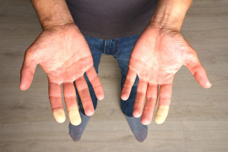 raynaud Encuentran la causa genética del fenómeno de Raynaud