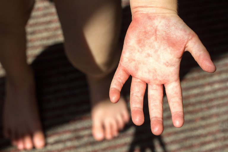 Coxsackie Virus Coxsackie en niños - Criar con Sentido Común